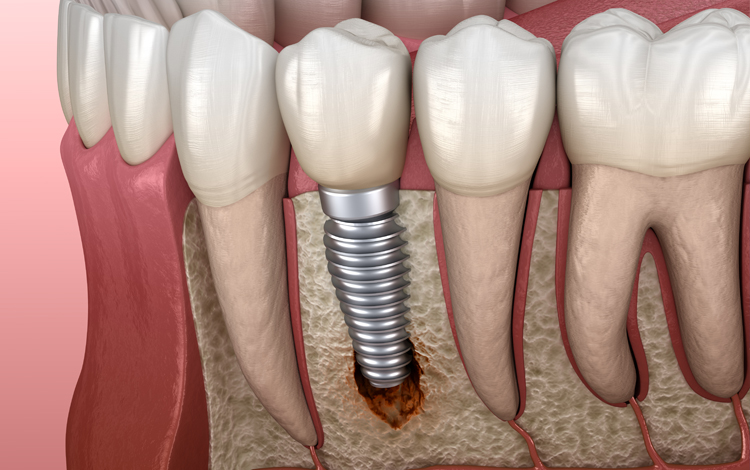 Entzündete Implantate behandeln Zahnklinik Dreiländereck Rheinfelden