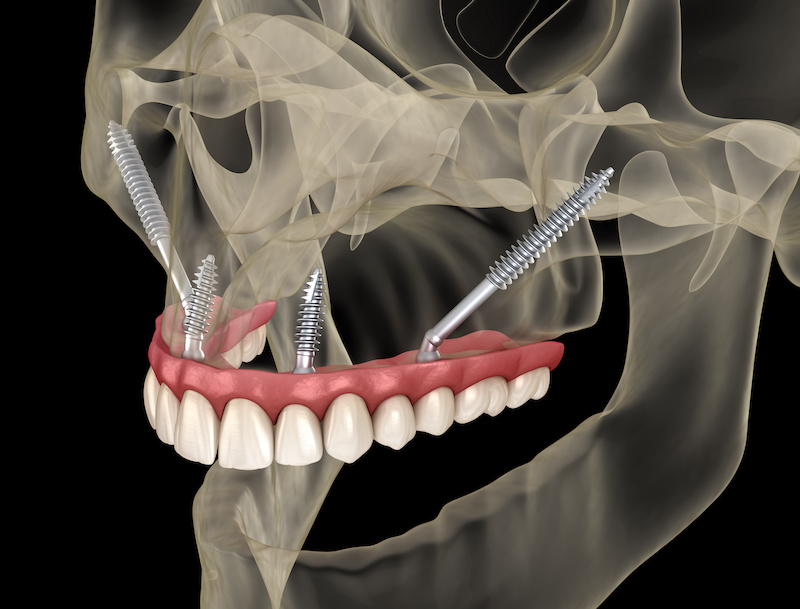 Zygoma Implantate Rheinfelden